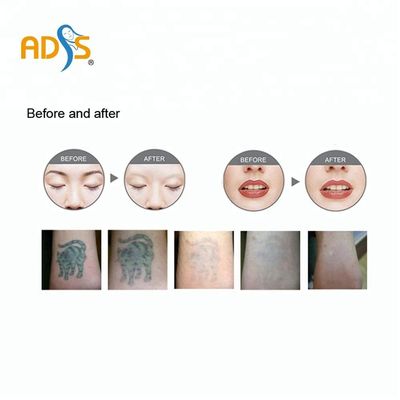 Q Switched Nd Yag Laser Pico Laser Penghilang Tato Mesin 1064nm 532nm