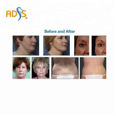 OEM Salon Thermage Mesin RF Pengencang Kulit Peralatan Kecantikan Pelangsing