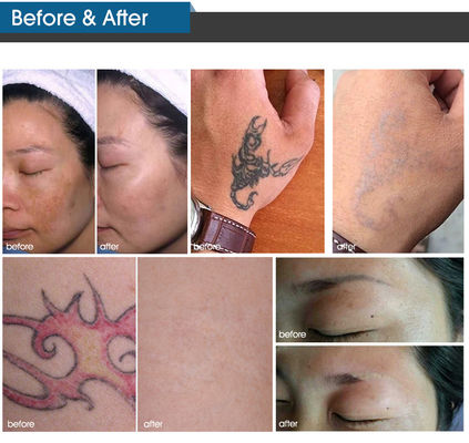 Mesin Laser Pikodetik Kecantikan Vertikal Mesin Laser Penghilang Pigmentasi